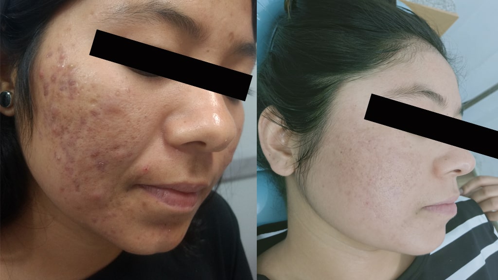 Before & After (ACNE)