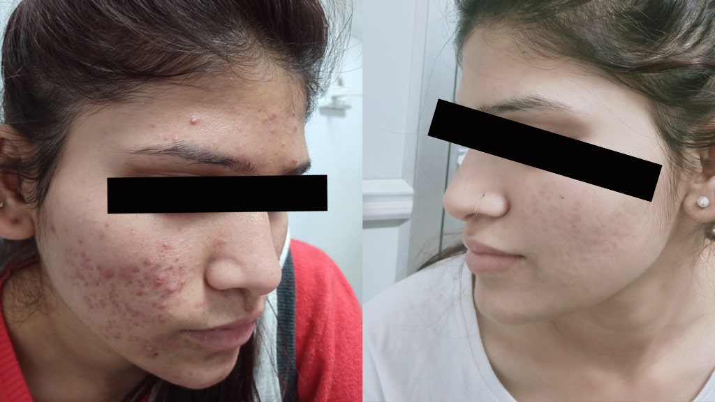 Before & After (ACNE)
