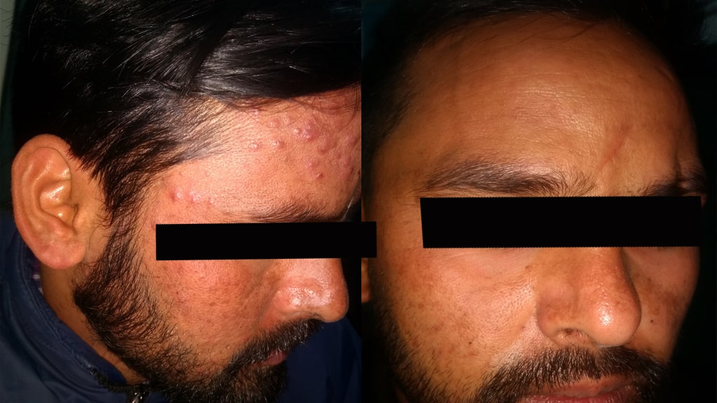 Before & After (ACNE)