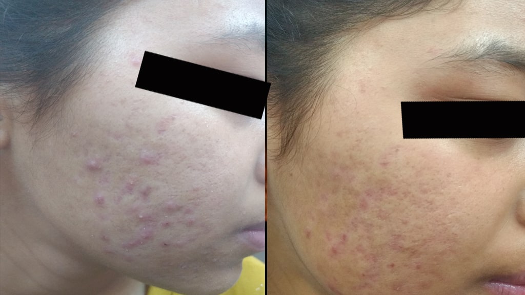 Before & After (ACNE)