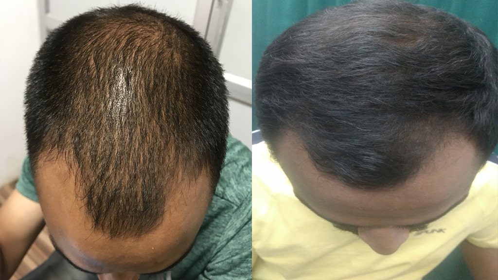 Before & After (AGA)