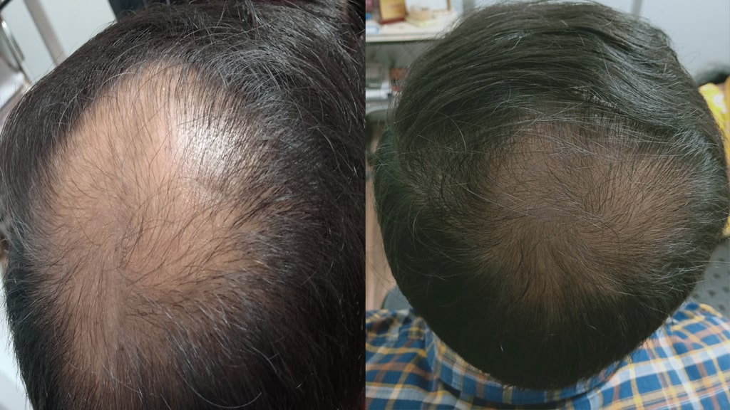 Before & After (AGA)