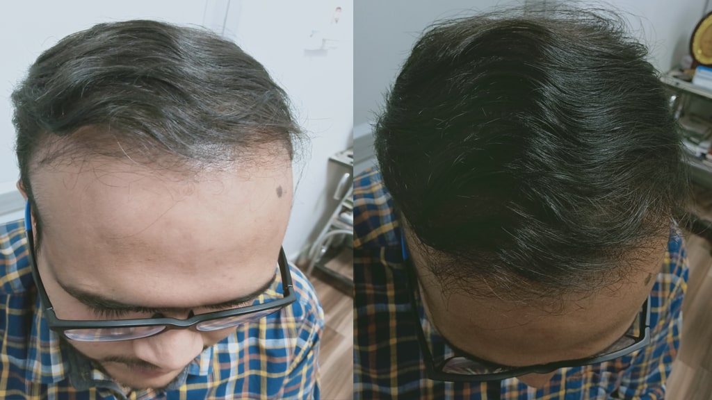 Before & After (AGA)