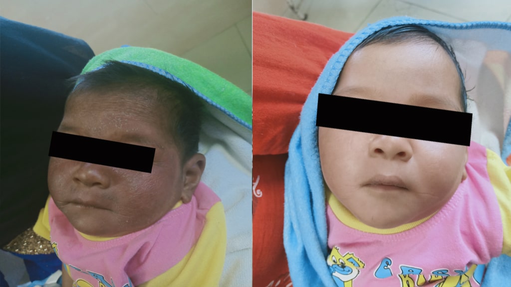 Before & After (ATOPIC)