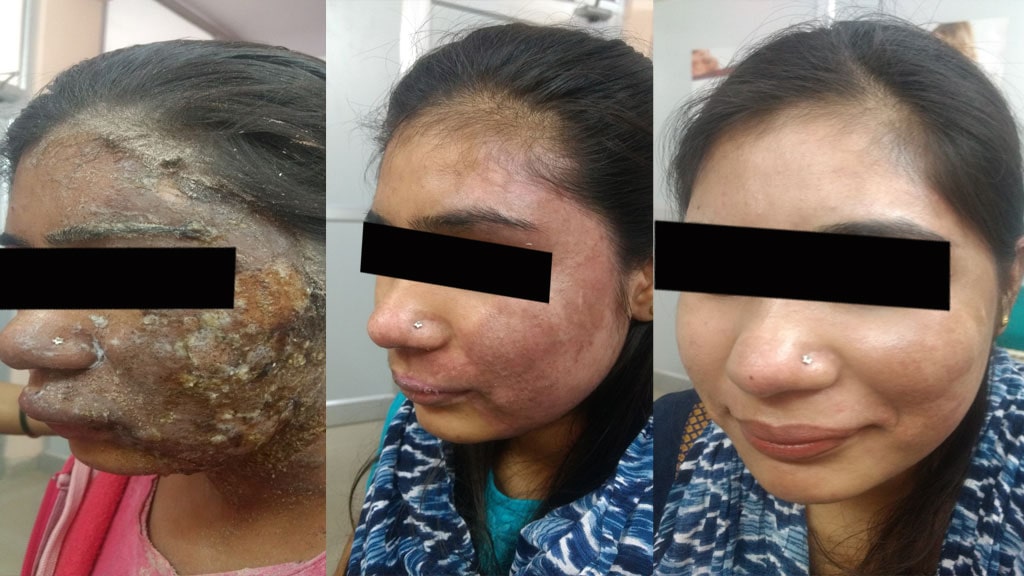 Before & After (BURN)
