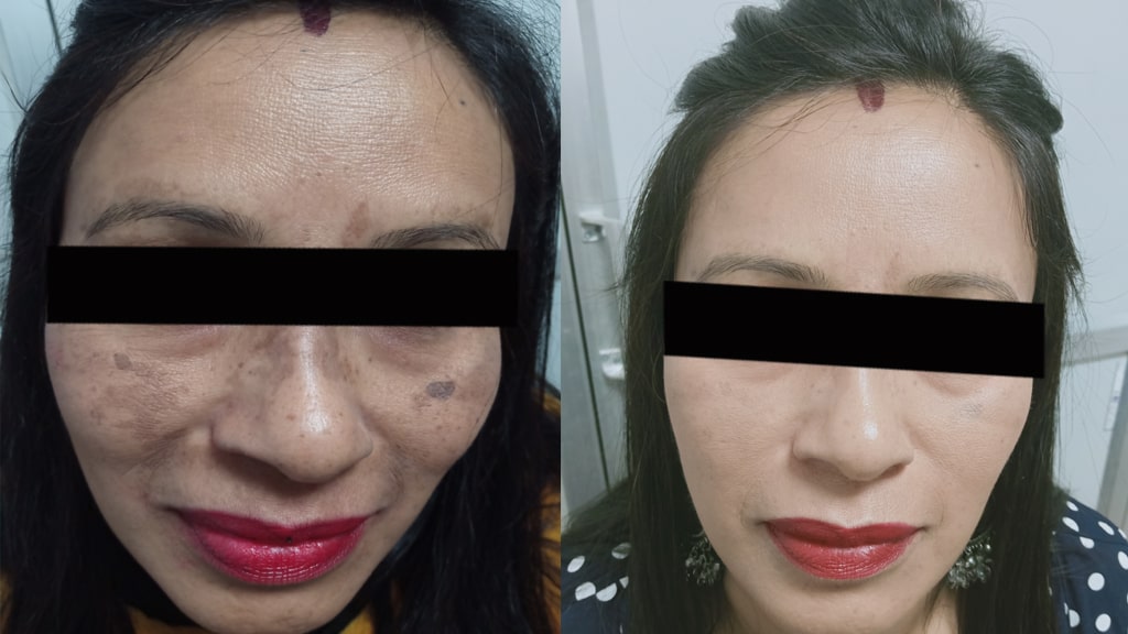 Before & After (MELASMA)