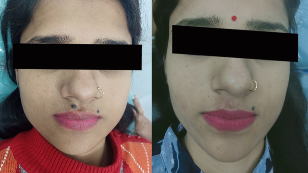 Before & After (MOLE)
