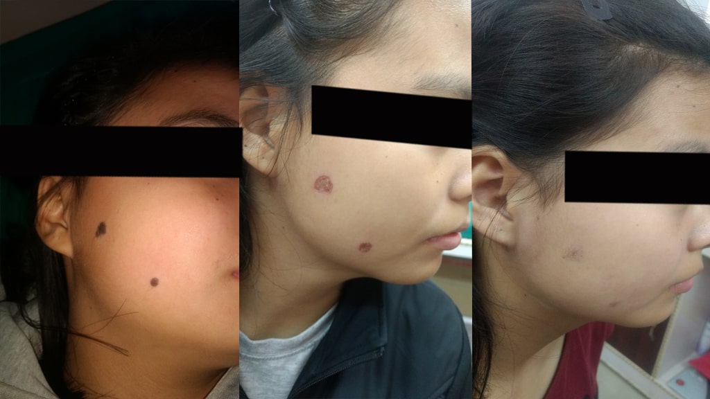 Before & After (MOLE)