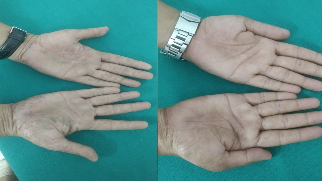 Before & After (NAIL)
