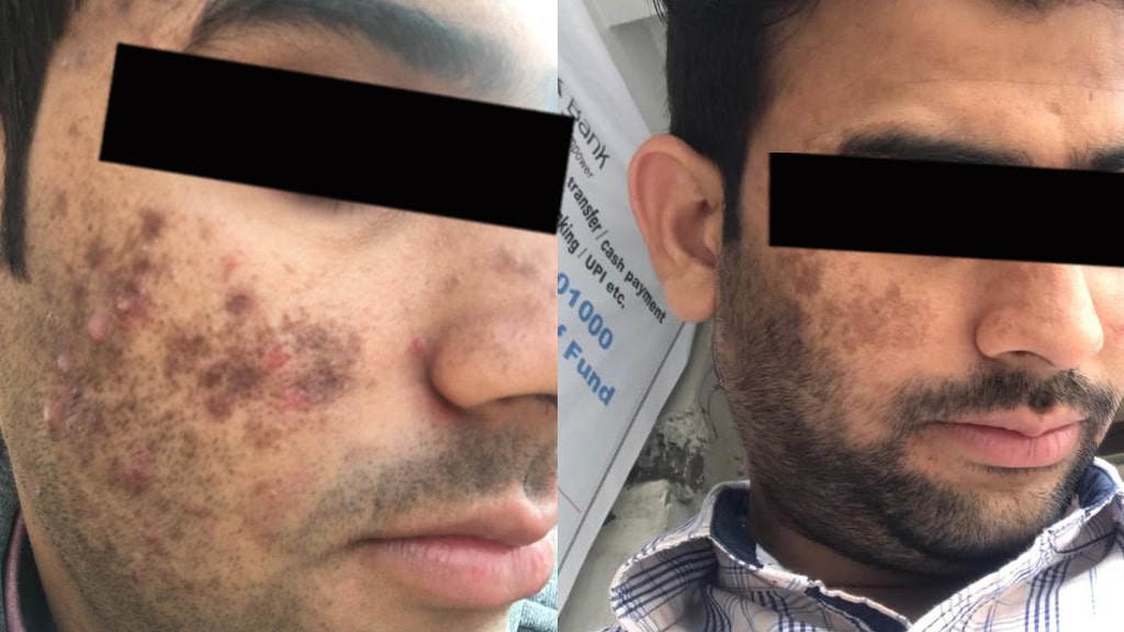 Before & After (PEEL)