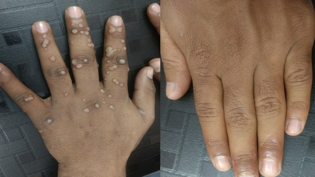 Before & After (WART HAND)