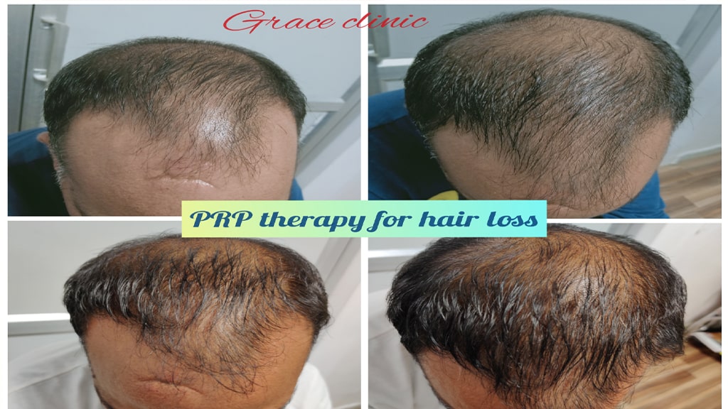 Before & After