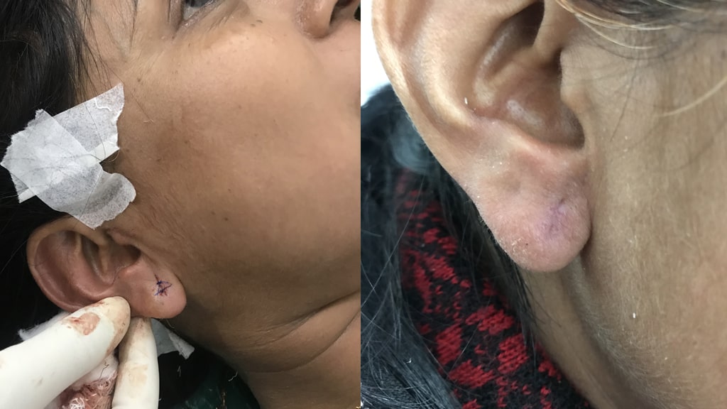 Before & After(Ear Lobe Repair)