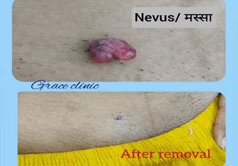 Before & After (ACNE)