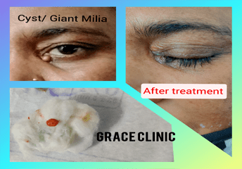 Before & After (ACNE)