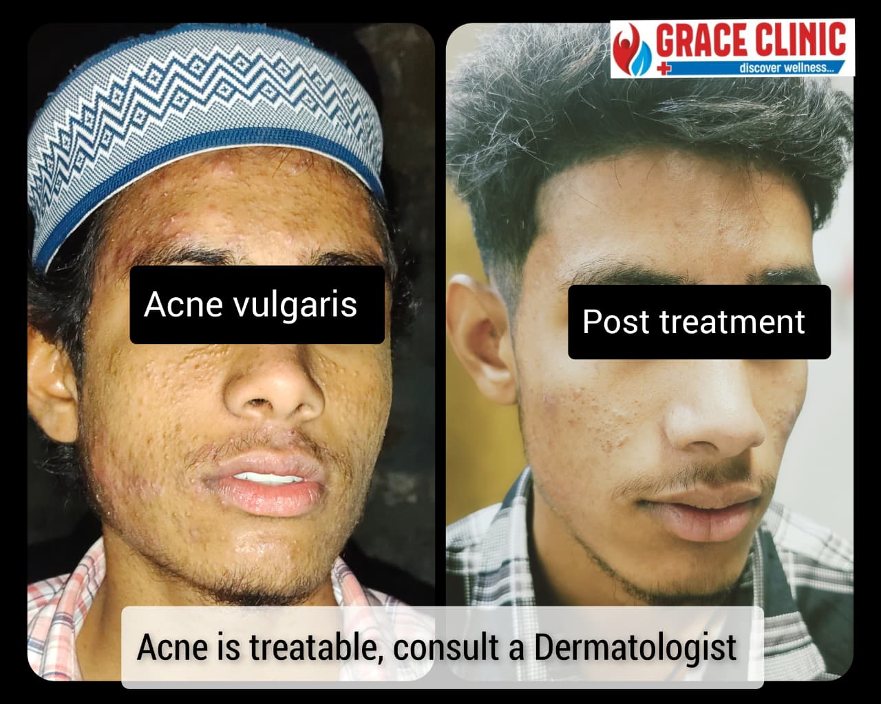 Severe acne before and after treatment