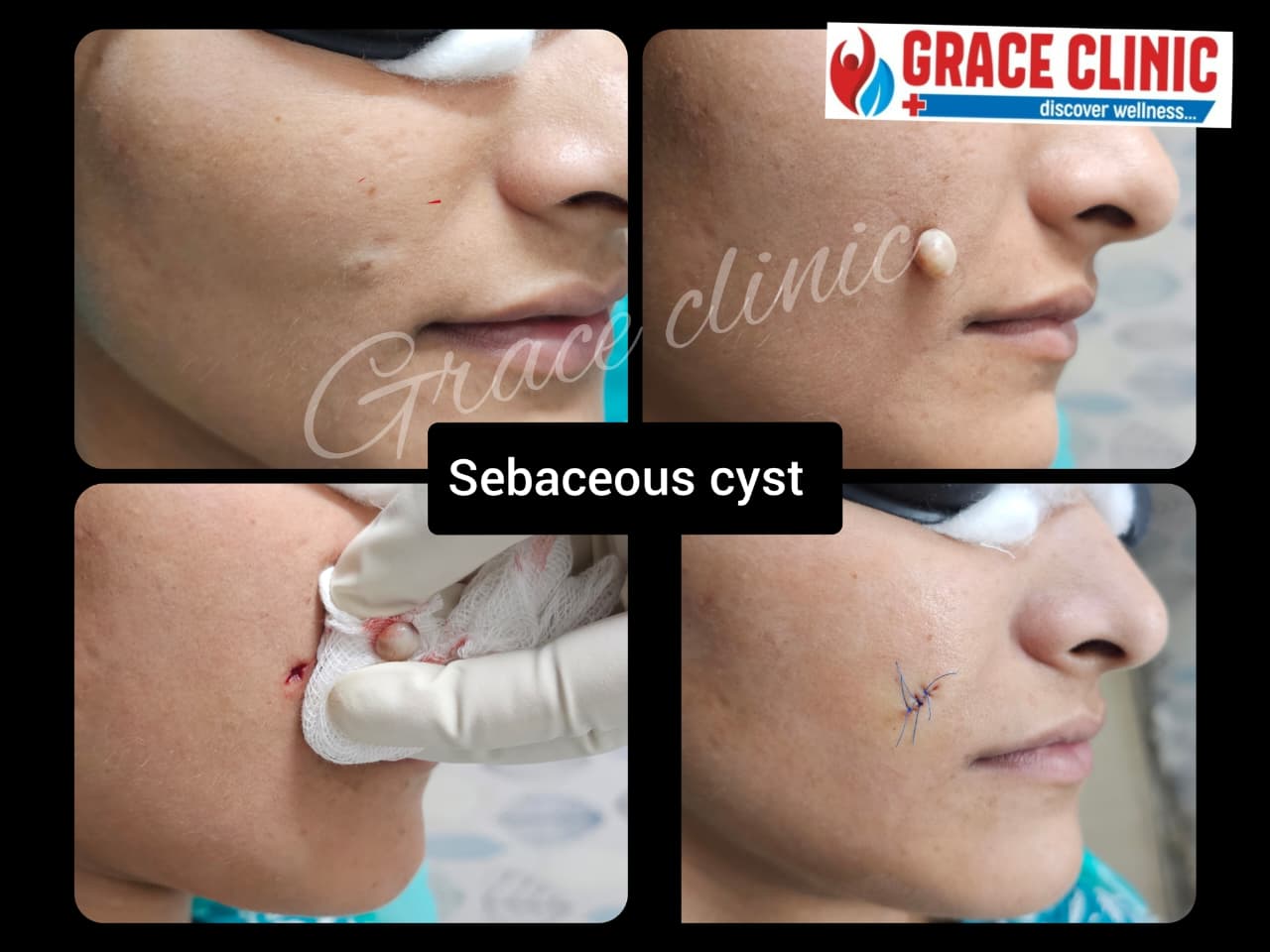 Sebaceous cyst excision