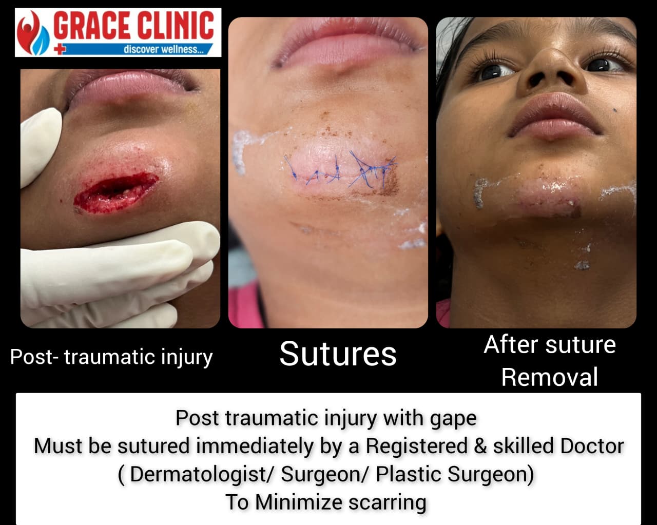 Trauma repair and suture removal